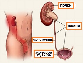 мочекаменная болезнь