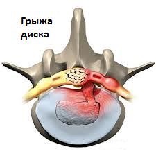 грыжа межпозвоночного диска