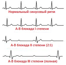 блокада сердца