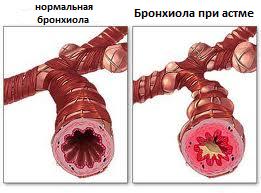 вид бронхов при астме