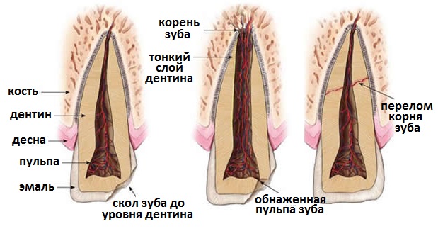 виды перелома зуба