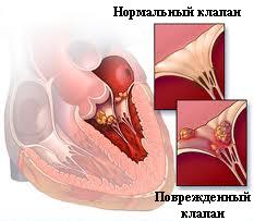 эндокардит