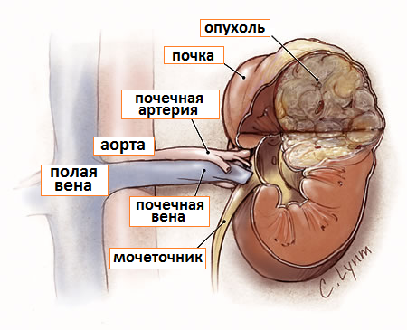 рак почки