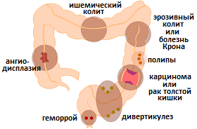 причины ректального кровотечения