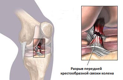 разрыв крестообразной связки