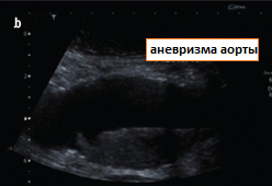 узи аневризмы брюшной аорты продольный вид