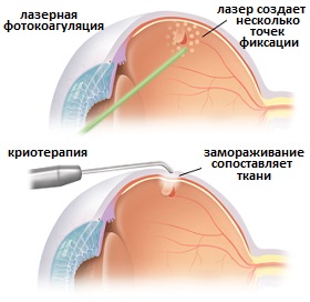 лазерное лечение отслоения сетчатки