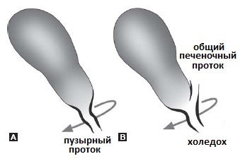 короткий пузырный проток