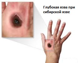 кожная форма сибирской язвы