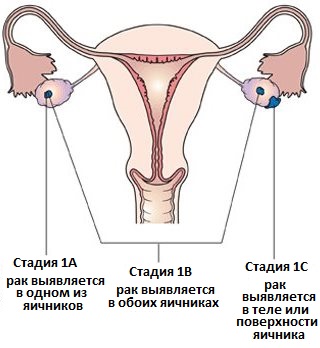 классификация рака яичников - 1 стадия