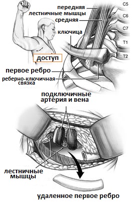 резекция 1 ребра