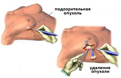 операция биопсии
