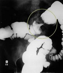 ирригоскопия при раке толстой кишки