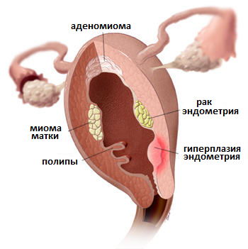 причины маточных кровотечений