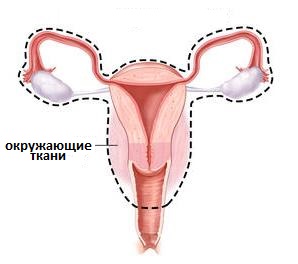 радикальная гистерэктомия при раке яичников