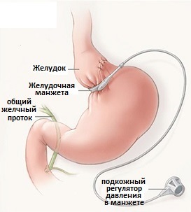 операция бандажирования желудка