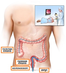 колоноскопия при колоректальном раке