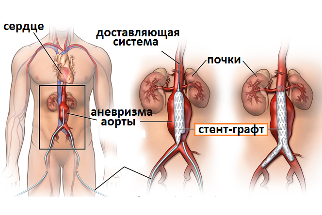 эндопротезирование аневризмы брюшной аорты