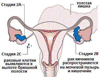 Классификация рака яичников - 2 стадия