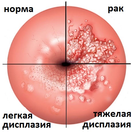 степени дисплазии матки при кольпоскопии