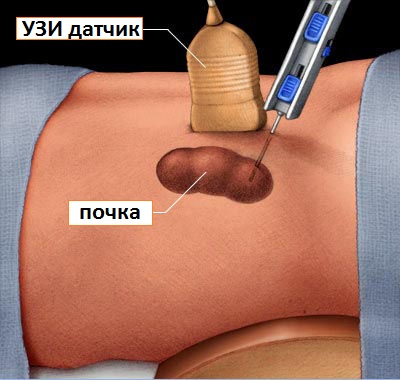 биопсия почки