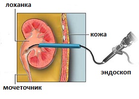 пункционная нефролитотомия и литоэкстракция