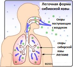 легочная форма сибирской язвы