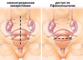 доступы при операциях по поводу кист яичников