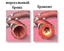 вид бронхов при бронхите