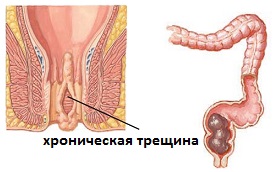 хроническая трещина прямой кишки