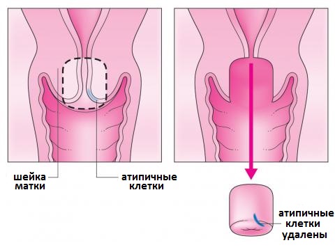 копизация при раке шейки матки