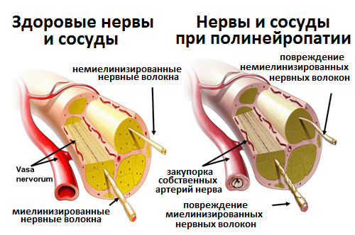 причины диабетической нейропатии