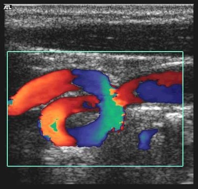 узи при патологической извитости сонной артерии
