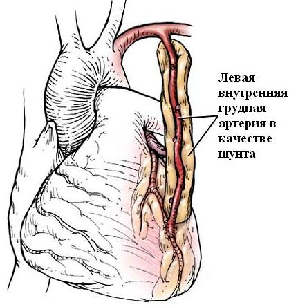 маммарокоронарное шунтирование