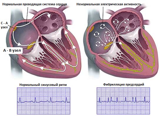 фибрилляция предсердий