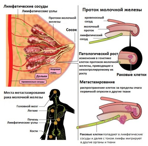протоковый рак молочной железы