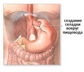 операция фундопликации