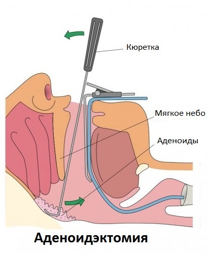 аденоидэктомия