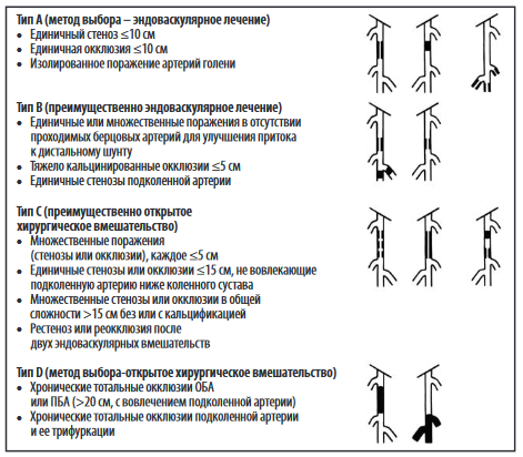 классификация TASC для бедренно-подколенных поражений