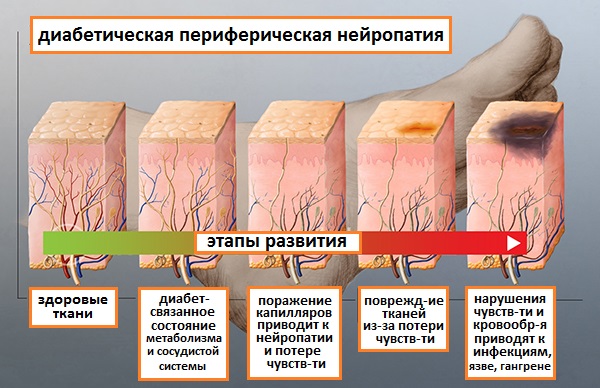 стадии нейропатии