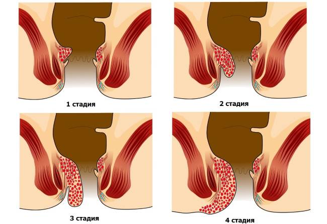 стадии внутреннего геморроя