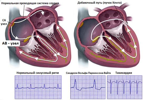 экг при синдроме вольф-паркинсона-вайта