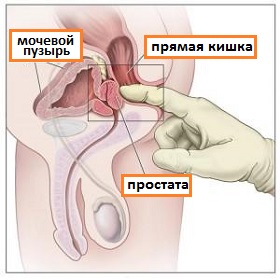 ректальное пальцевое исследование простаты