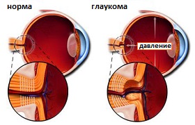 причина глаукомы